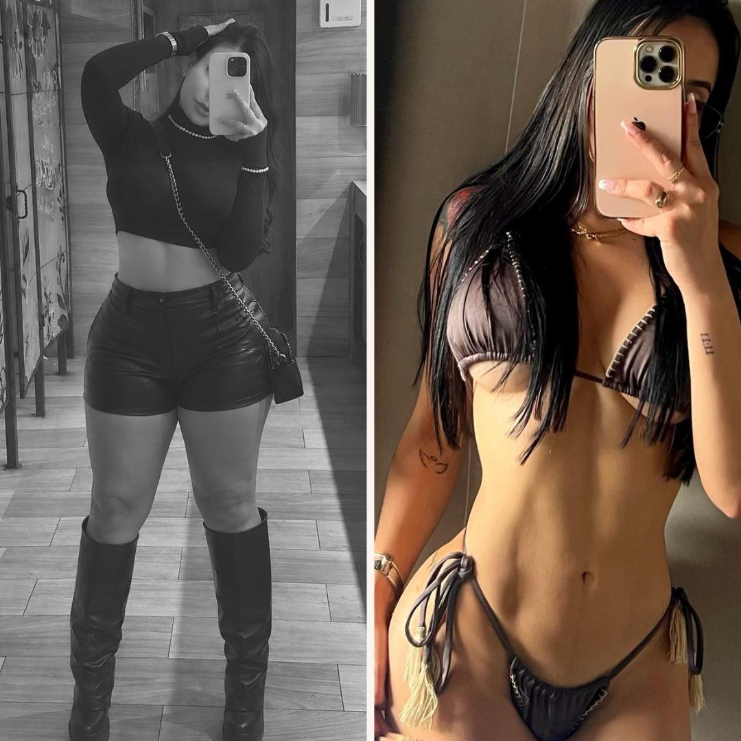 Antes y después del tratamiento BALMA — Elena M.