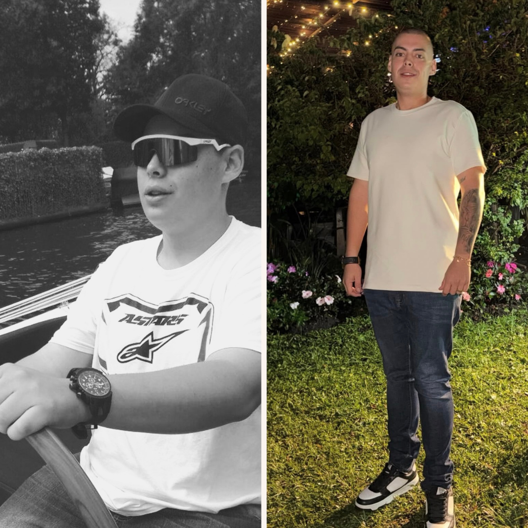 Antes y después del tratamiento BALMA — Sebastian G.